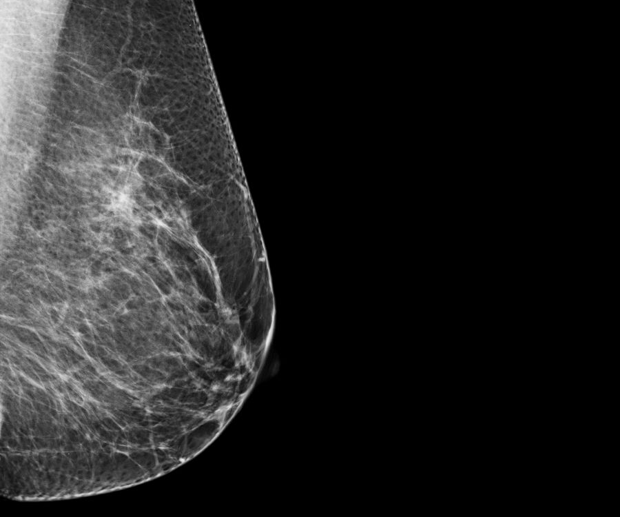 breast-mammogram